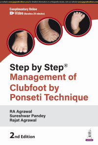 Image of Management of Clubfoot by Ponseti Technique