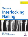 Tanna’s Interlocking Nailing